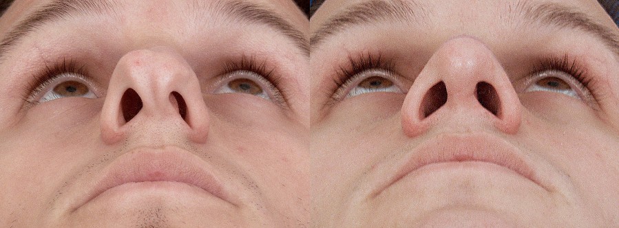 Deviated septum best sale
